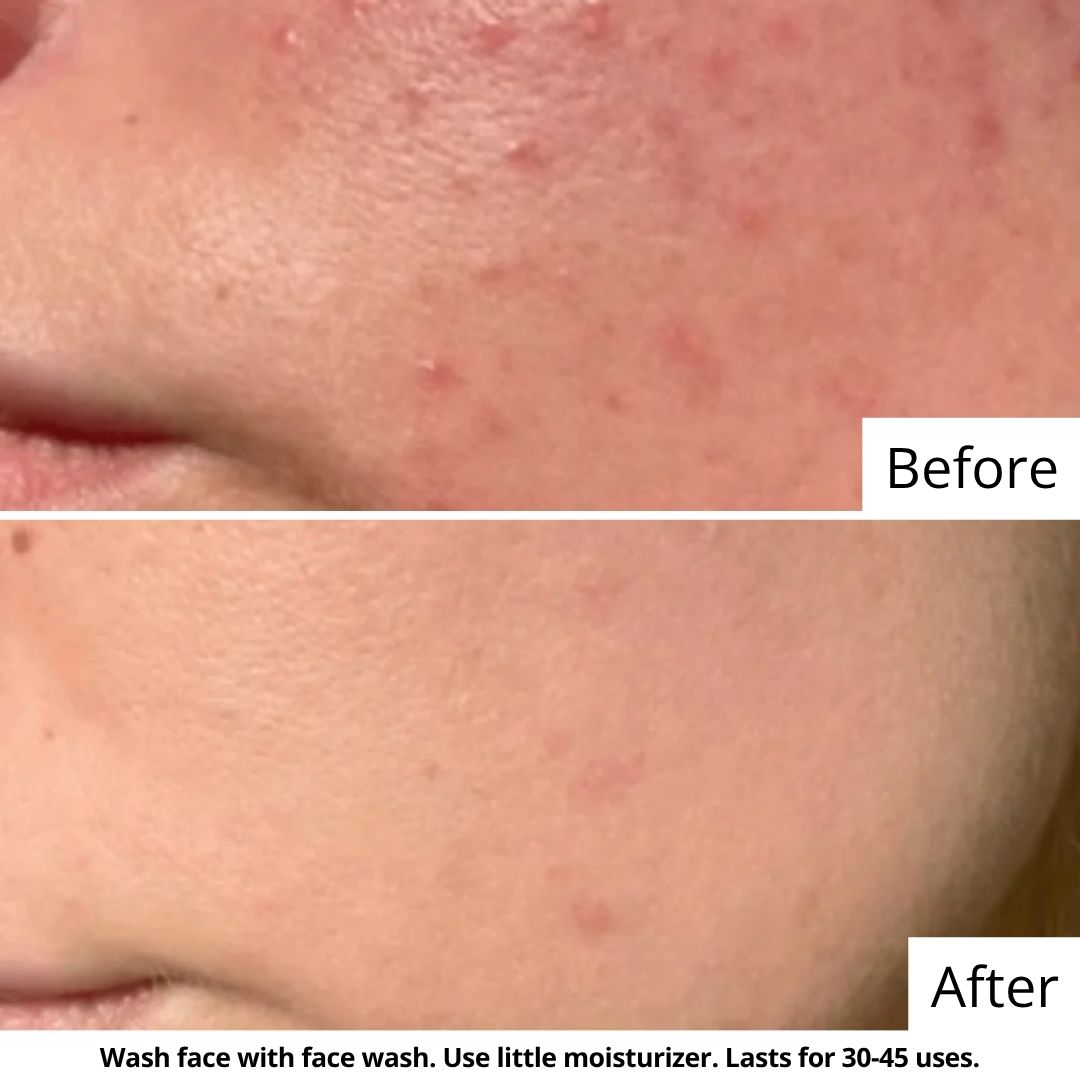 Oil & Acne Exfoliating Combo