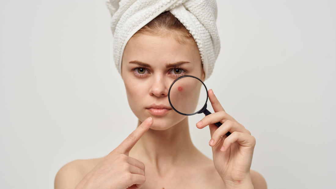 How to Fight Acne this Summer