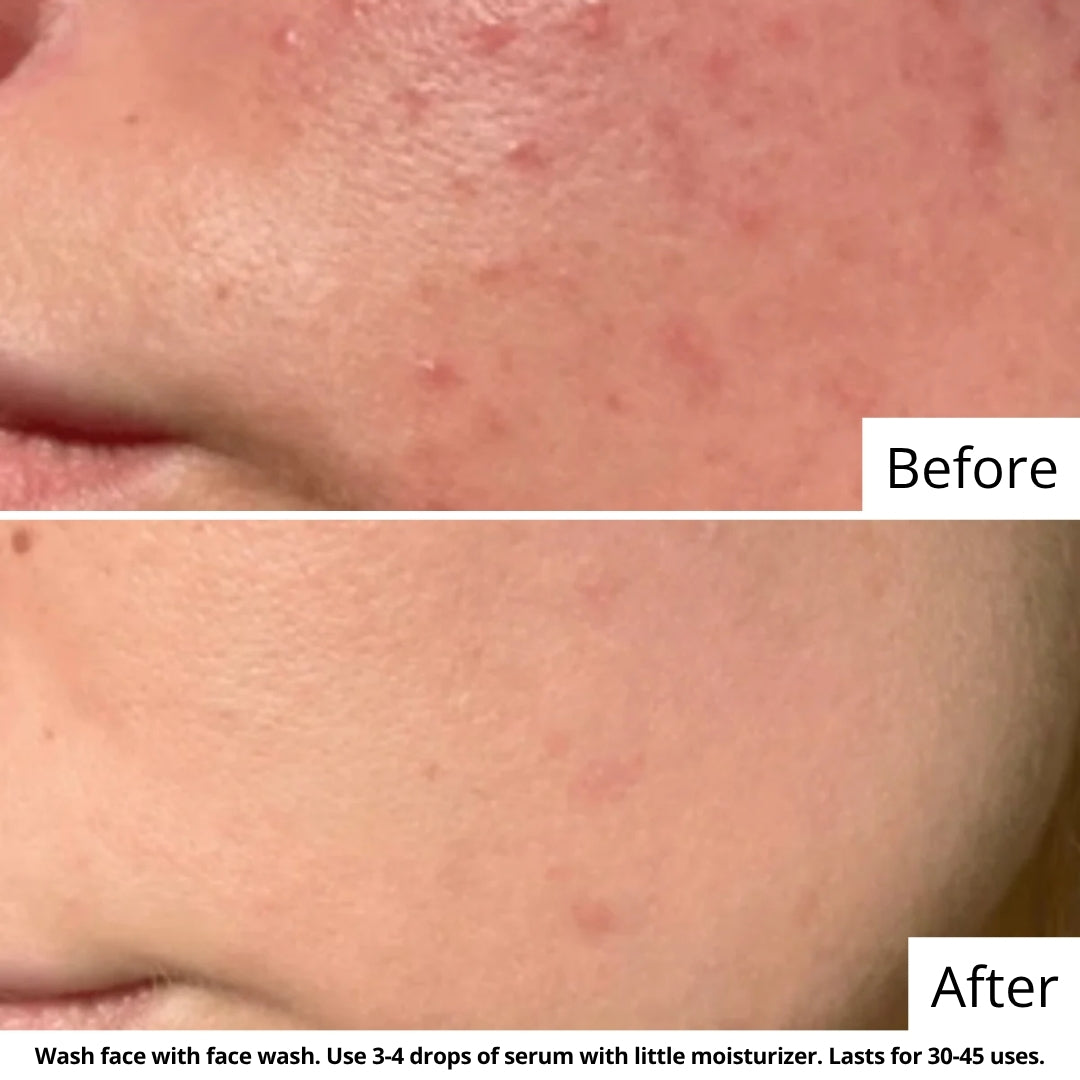 Acne and Pore Health Regime