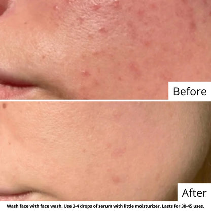 Acne and Pore Health Regime