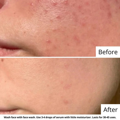 Sun Damage & Acne Protection Combo